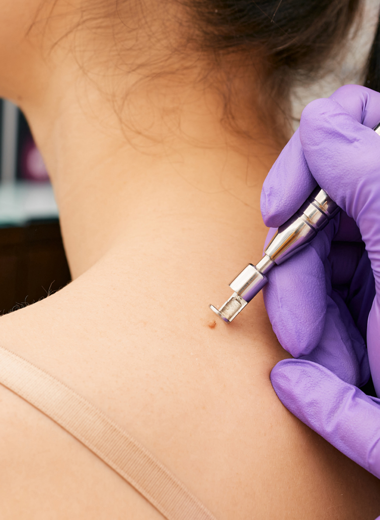 removing lesion from woman's neck